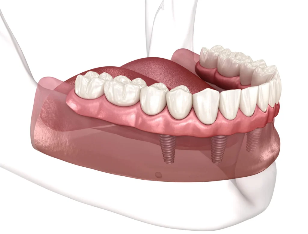 Illustration of full-mouth dental implants in Bethesda, MD.