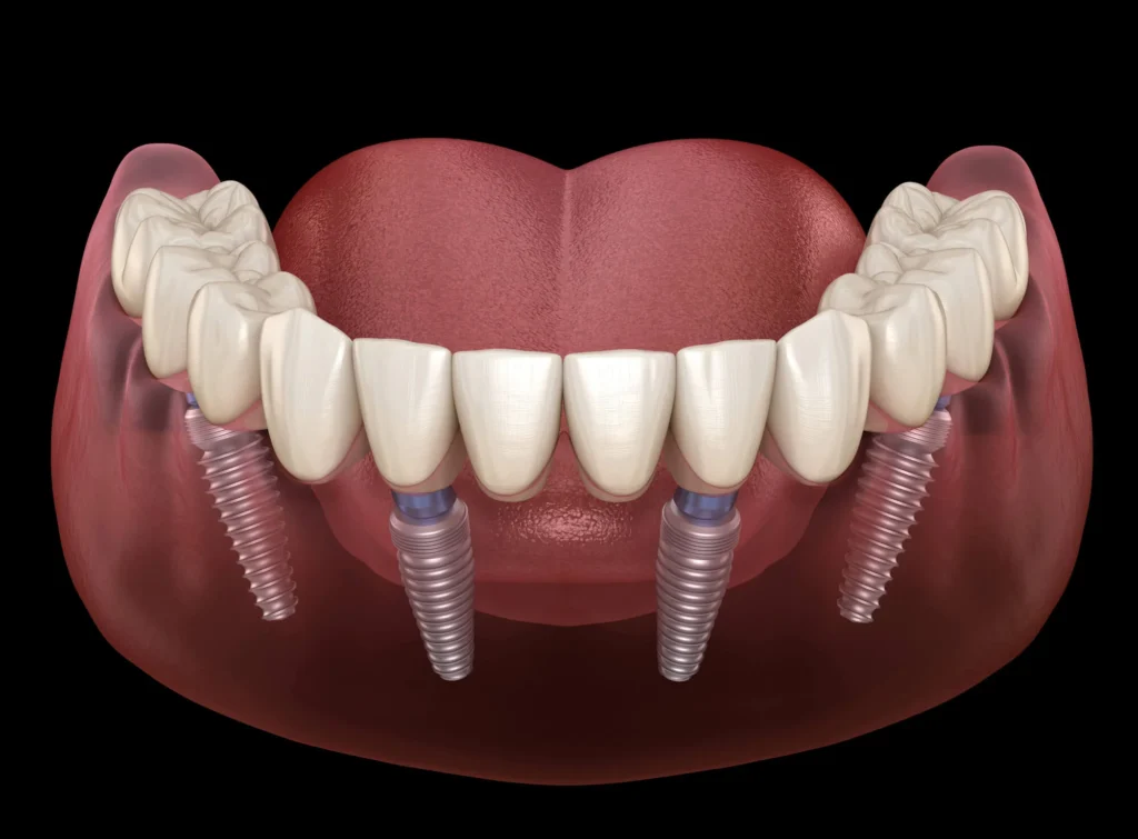 Maxillary and mandibular full-mouth dental implants in Bethesda, MD.
