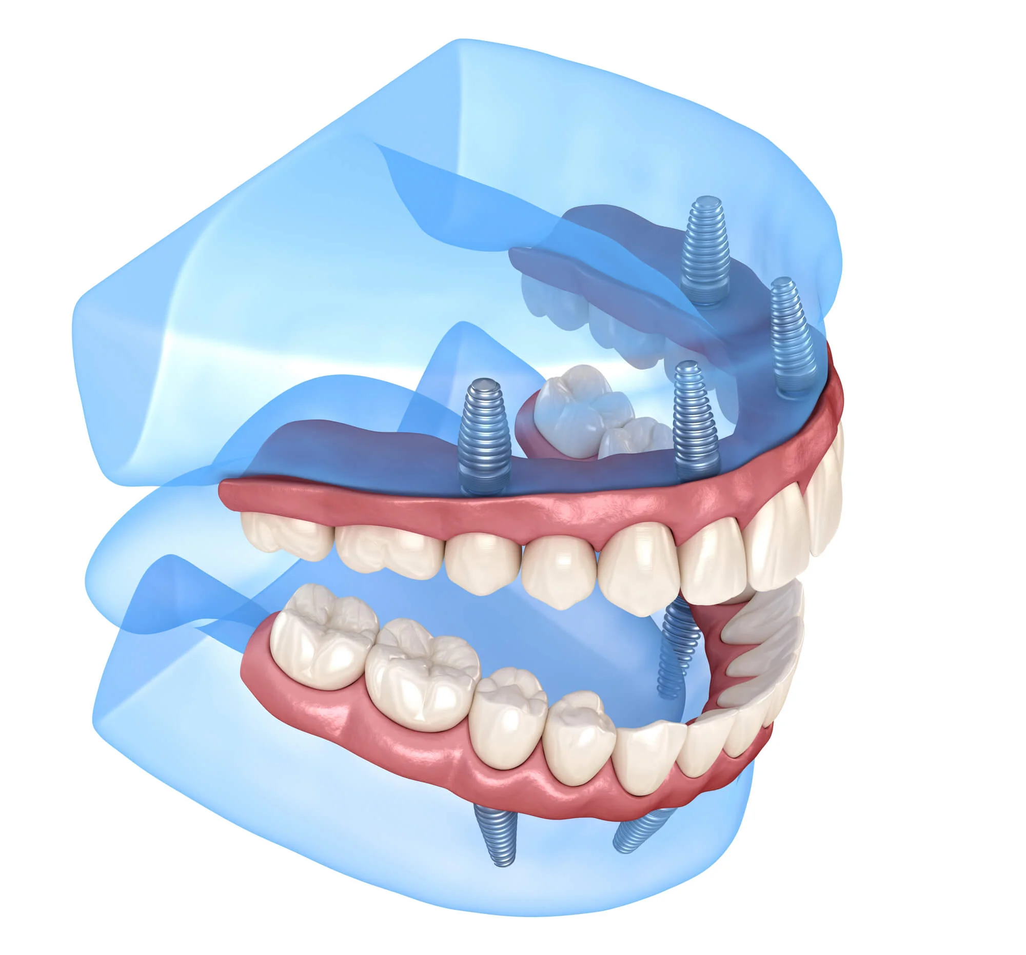 Removable full-mouth dental implants in Bethesda, MD.