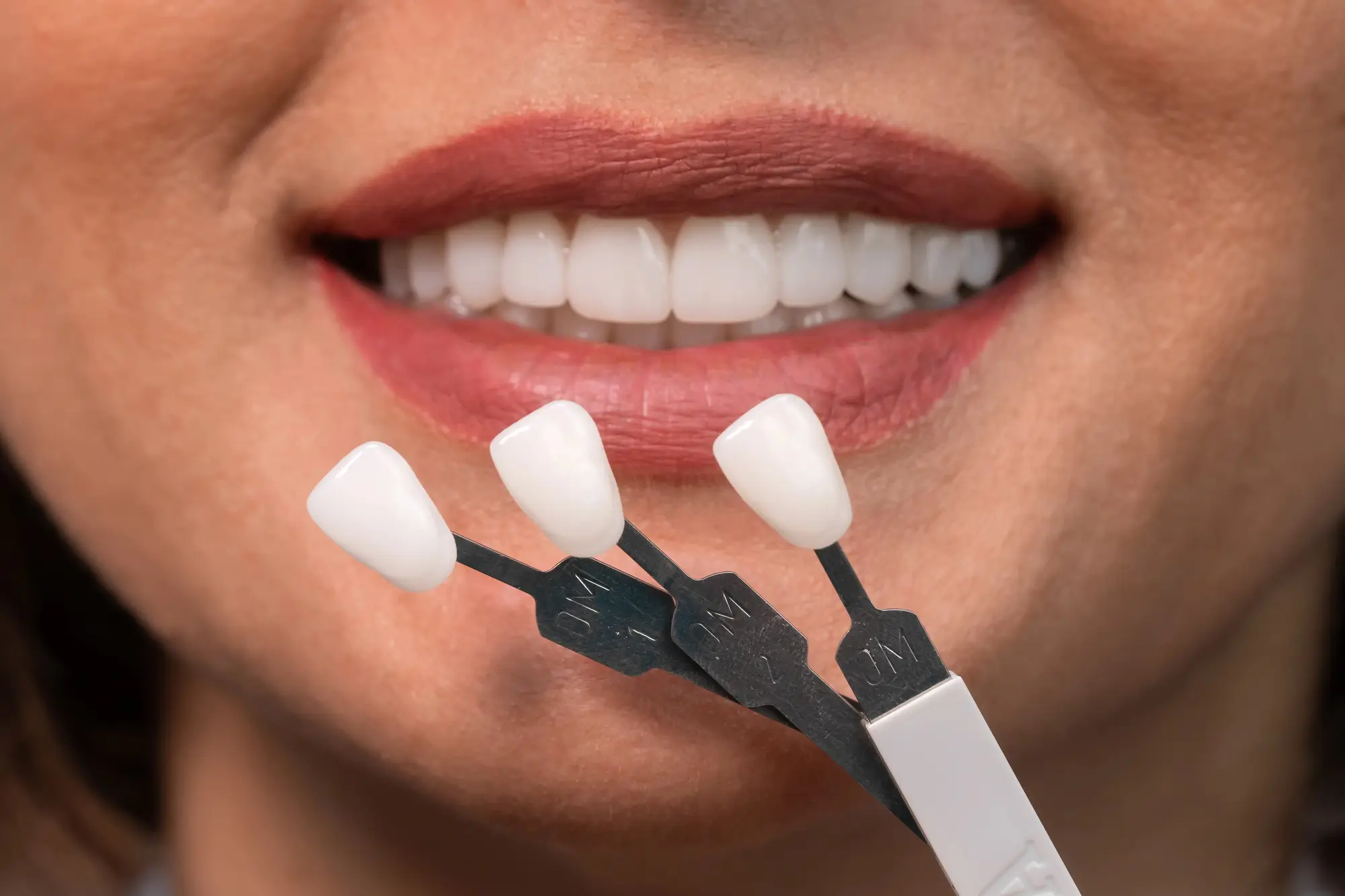 Shade-Selection-for-Smile-Makeover-in-Bethesda